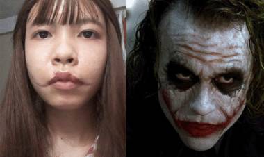 Cô gái sở hữu gương mặt như Joker sau tai nạn thang máy cầu cứu